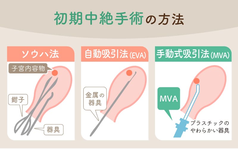 初期中絶手術の方法