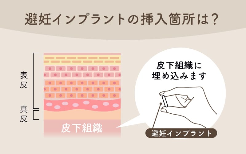 避妊インプラントの挿入箇所は？