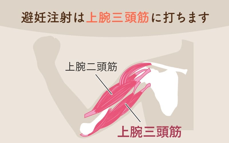 避妊注射は3カ月に1回、筋肉注射または皮下注射で行います