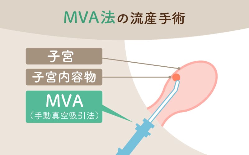 流産手術の方法・「吸引法(MVA法)」